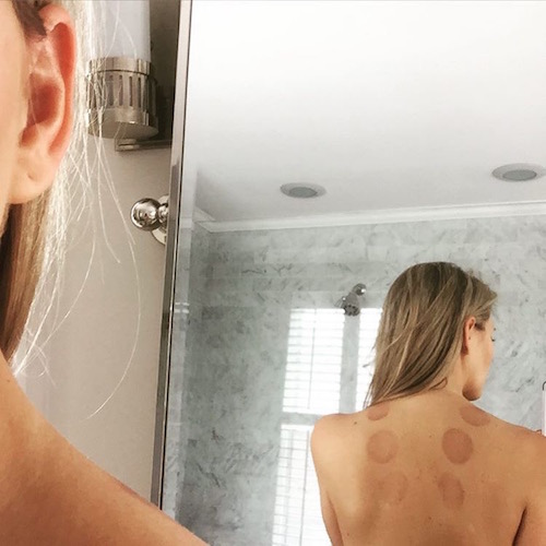 the benefits of cupping on barebeauty.com